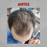 Kit Anticalvície: PantôHF turbinado + Minoxidil Power - Homem