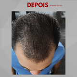 Kit Anticalvície: PantôHF turbinado + Minoxidil Power - Homem