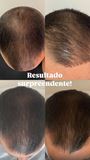 Kit Anticalvície: PantôHF turbinado + Minoxidil Power - Homem