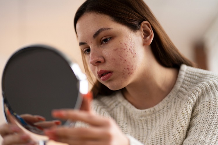 Acne - Pele acneica